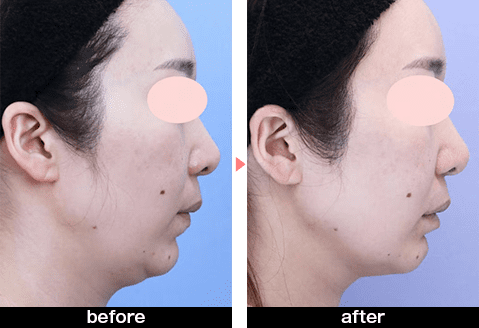 ウルトラリフトプラスHIFUの症例写真before・after