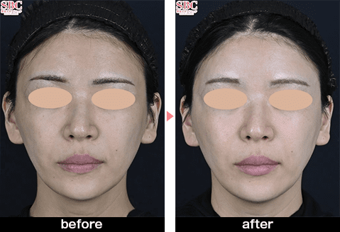 ウルセラの症例写真before・after