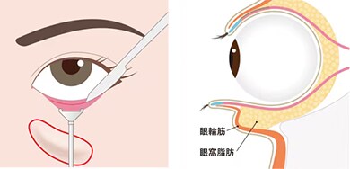 手術の流れ イメージ2