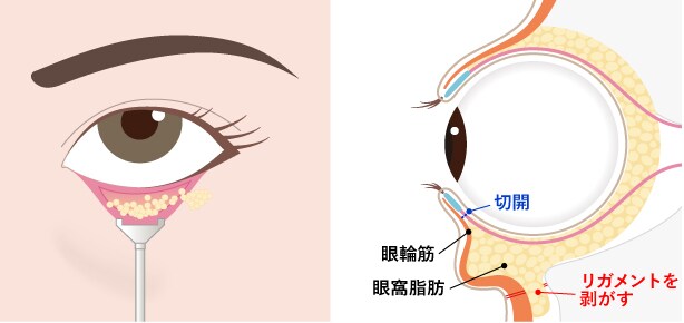 手術の流れ イメージ3