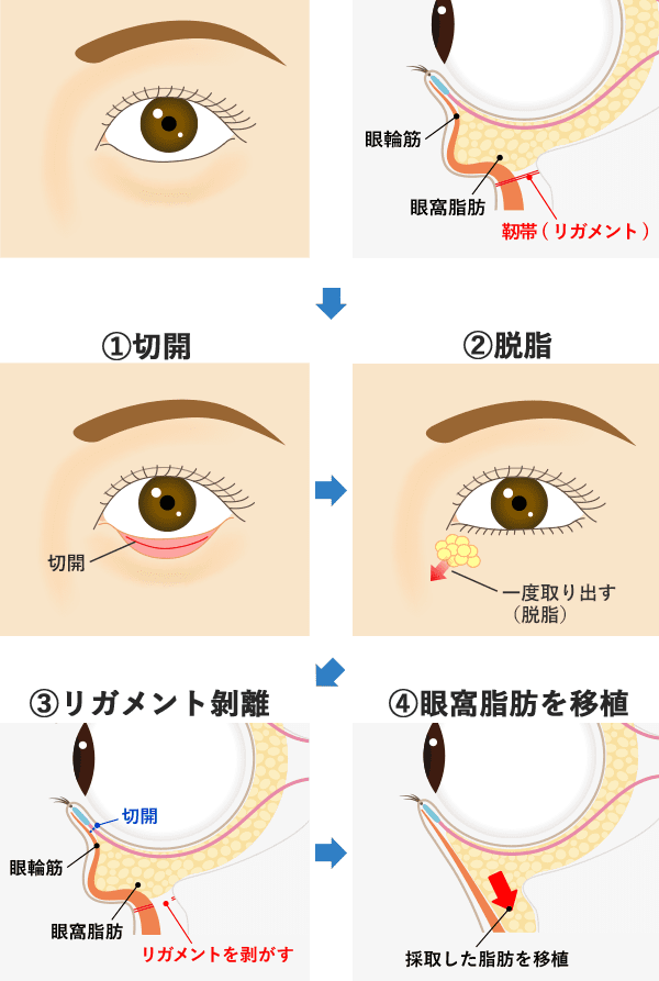 裏ハムラ法とは イメージ1