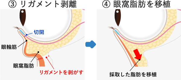 リガメント剥離とは イメージ2