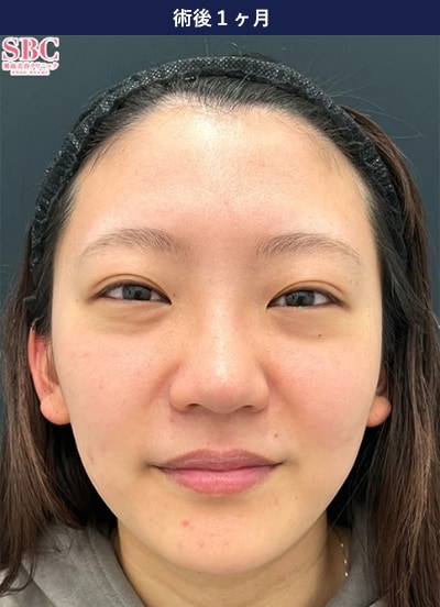 裏ハムラ法の症例写真 手術後2年 1