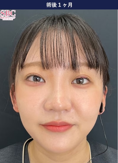 裏ハムラ法の症例写真 手術後2年 2