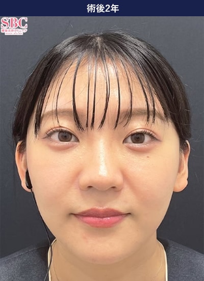 裏ハムラ法の症例写真 手術後2年 3