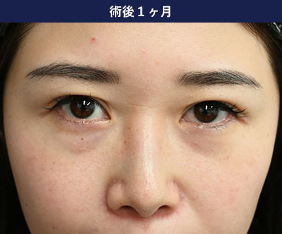 裏ハムラ法の症例写真 手術後3年 1