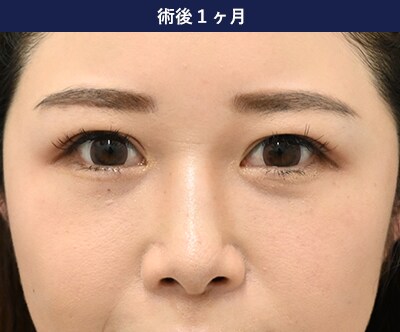 裏ハムラ法の症例写真 手術後3年 2