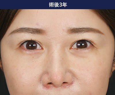 裏ハムラ法の症例写真 手術後3年 3