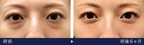 裏ハムラ法の症例写真 術前 術後6ヶ月（湘南美容クリニック医師）