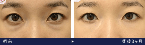 裏ハムラ法の症例写真 術前 術後3ヶ月（湘南美容クリニック医師）