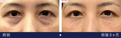 裏ハムラ法の症例写真 術前 術後3ヶ月（湘南美容クリニック医師）