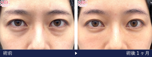 裏ハムラ法の症例写真（金沢 豪 医師）