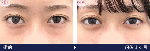 裏ハムラ法の症例写真（小竹 将 医師）