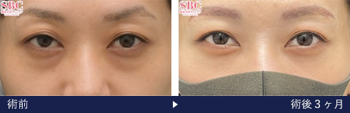 裏ハムラ法の症例写真（菅原 佑太 医師）