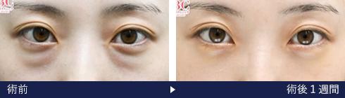 裏ハムラ法の症例写真（東 大輝 医師）