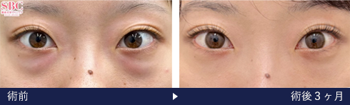 裏ハムラ法の症例写真（上岡 利一 医師）