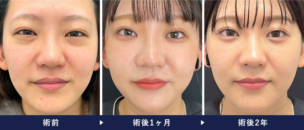 裏ハムラ法の症例写真 手術後2年