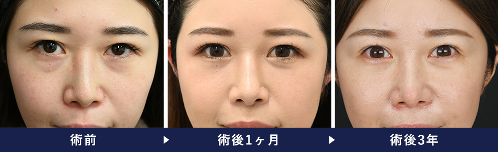 裏ハムラ法の症例写真 手術後3年