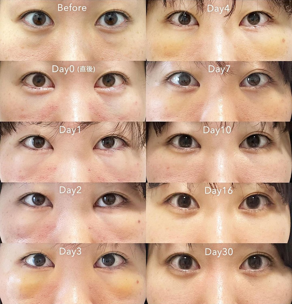 裏ハムラ法の術後経過イメージ