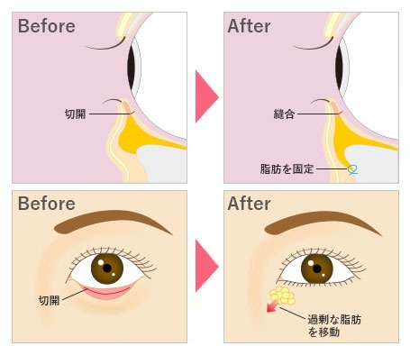 裏ハムラ法の施術方法