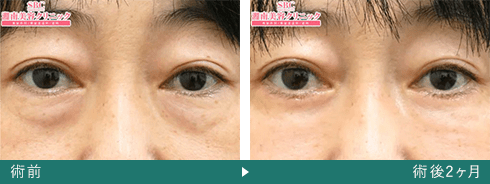 切開ハムラ法の症例写真（飯田 秀夫 医師）