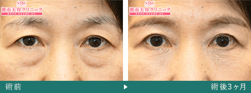 切開ハムラ法の症例写真（飯田 秀夫 医師）