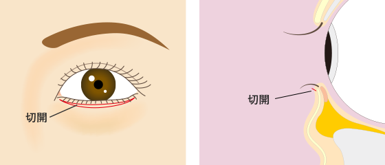 下まぶたの際（キワ）を切開