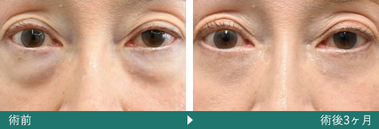 表ハムラ(切開ハムラ)法の症例写真（坂西 寛信 医師）