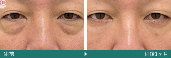 表ハムラ(切開ハムラ)法の症例写真（上岡 利一 医師）