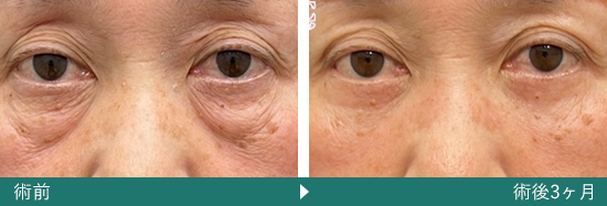 表ハムラ(切開ハムラ)法の症例写真（迫田 拓弥 医師）