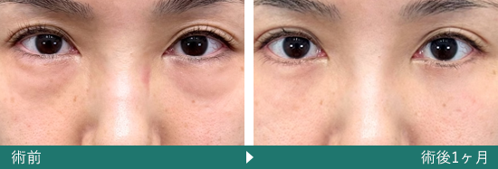 表ハムラ(切開ハムラ)法の症例写真（松阪 佑介 医師）