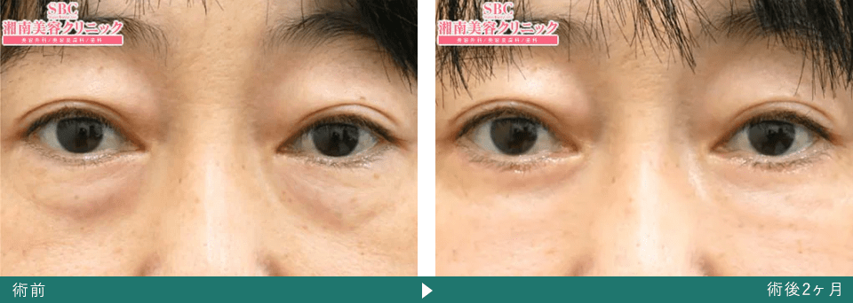 切開ハムラ法のピックアップ症例写真（術後3ヶ月後）