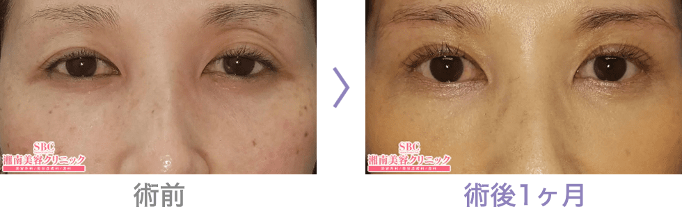 目の上のたるみ取りなら眉下リフト 眉下切開 若返り エイジングケアなら湘南美容クリニック 公式 目の上のたるみ取りなら眉下リフト 眉下切開 若返り エイジングケアなら湘南美容クリニック 公式