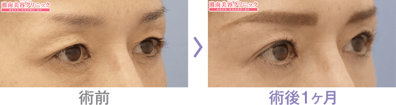 目の上のたるみ取りなら眉下リフト 眉下切開 若返り エイジングケアなら湘南美容クリニック 公式
