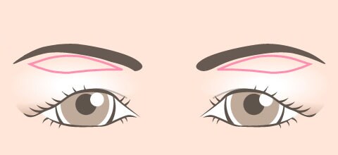 皮膚切除のデザイン