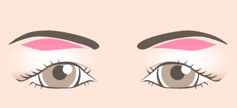 余剰皮膚の切除