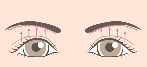 眉下ラインに沿って縫合