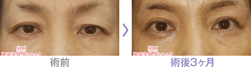 眉下リフト（眉下切開）の症例写真ビフォーアフター2