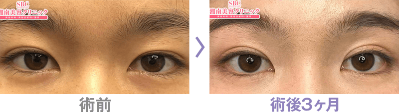 眉下リフト（眉下切開）の症例写真ビフォーアフター1