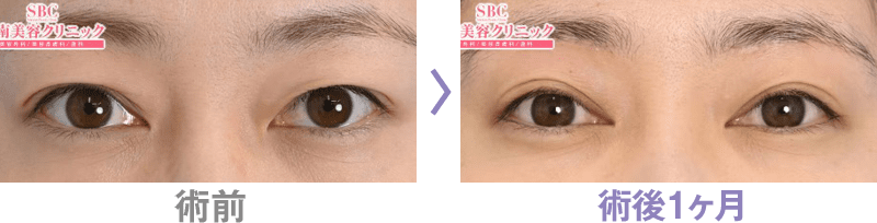 眉下リフト（眉下切開）の症例写真ビフォーアフター3