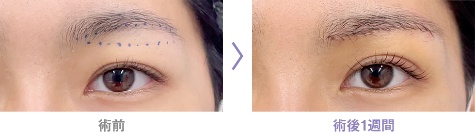 眉下リフト(眉下切開)のピックアップ症例写真4