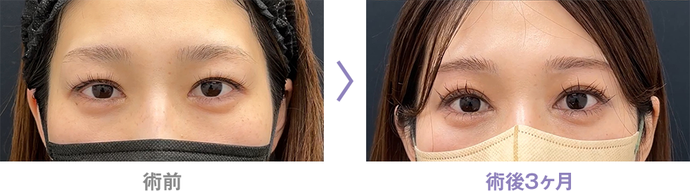 眉下リフト(眉下切開)のピックアップ症例写真5