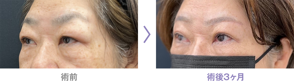 眉下リフト(眉下切開)のピックアップ症例写真6