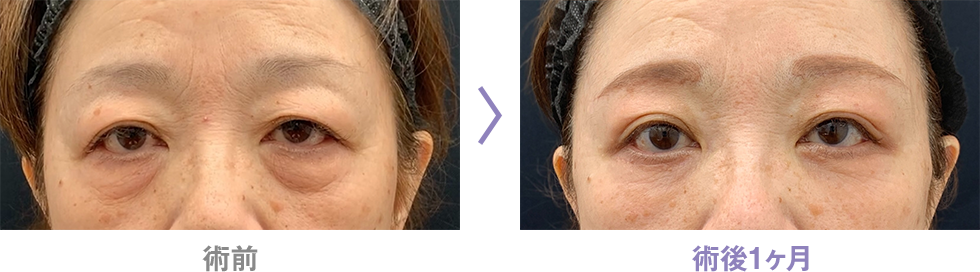 眉下リフト(眉下切開)のピックアップ症例写真7