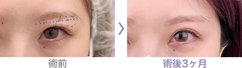 眉下リフト(眉下切開)はこのような方におすすめ 症例写真1