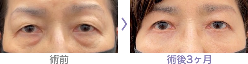眉下リフト(眉下切開)はこのような方におすすめ 症例写真2