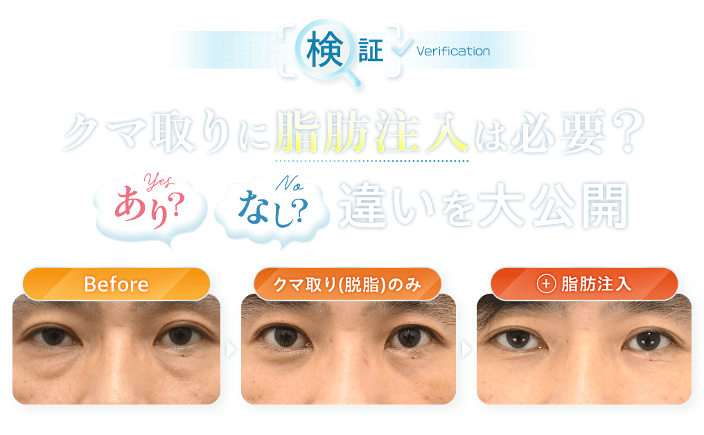 検証 クマ取りに脂肪注入は必要?あり?なし?違いを大公開