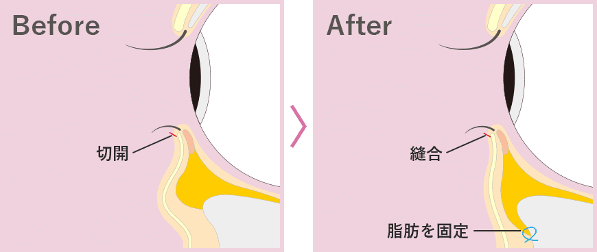 切開ハムラ法