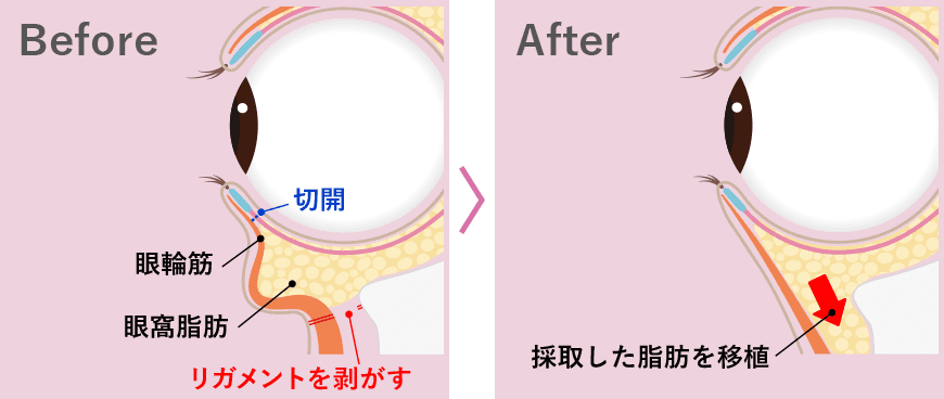 ミニ裏ハムラ法