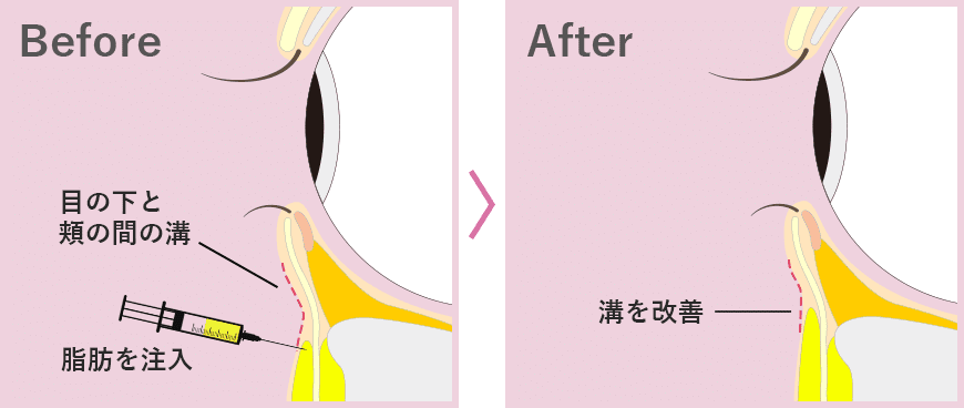 ナチュラル脂肪注射